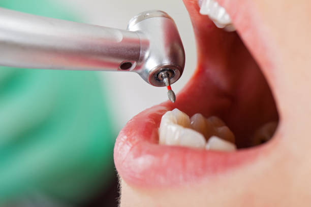 Best Emergency Wisdom Tooth Extraction in Bithlo, FL
